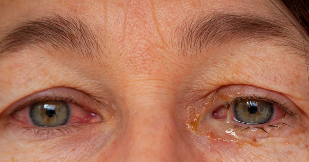 Göz yanması nedir? Göz yanmasının belirtileri ve tedavisi