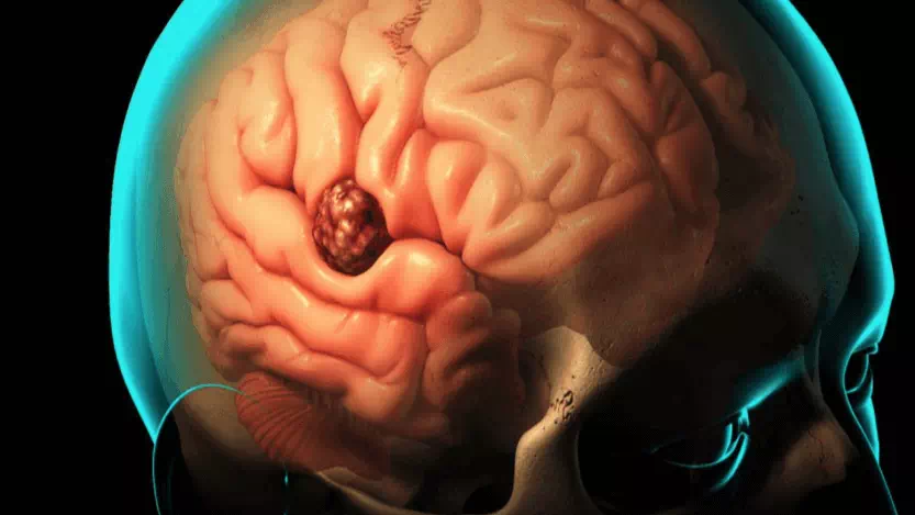 Beyin Tümörü Nedir?