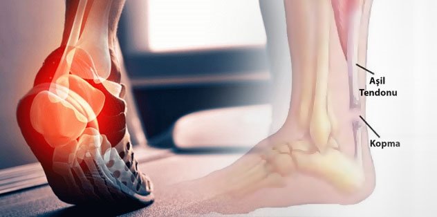 Aşil tendonu zedelenmesinde ve kopmasında neler yapılır?