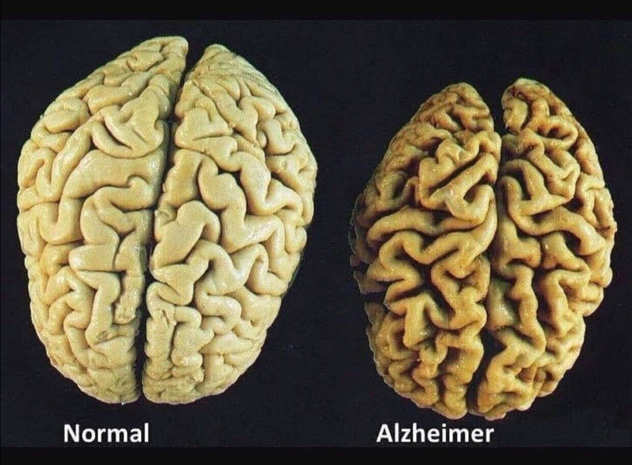 Alzheimer hastasının beyninde ne olur?