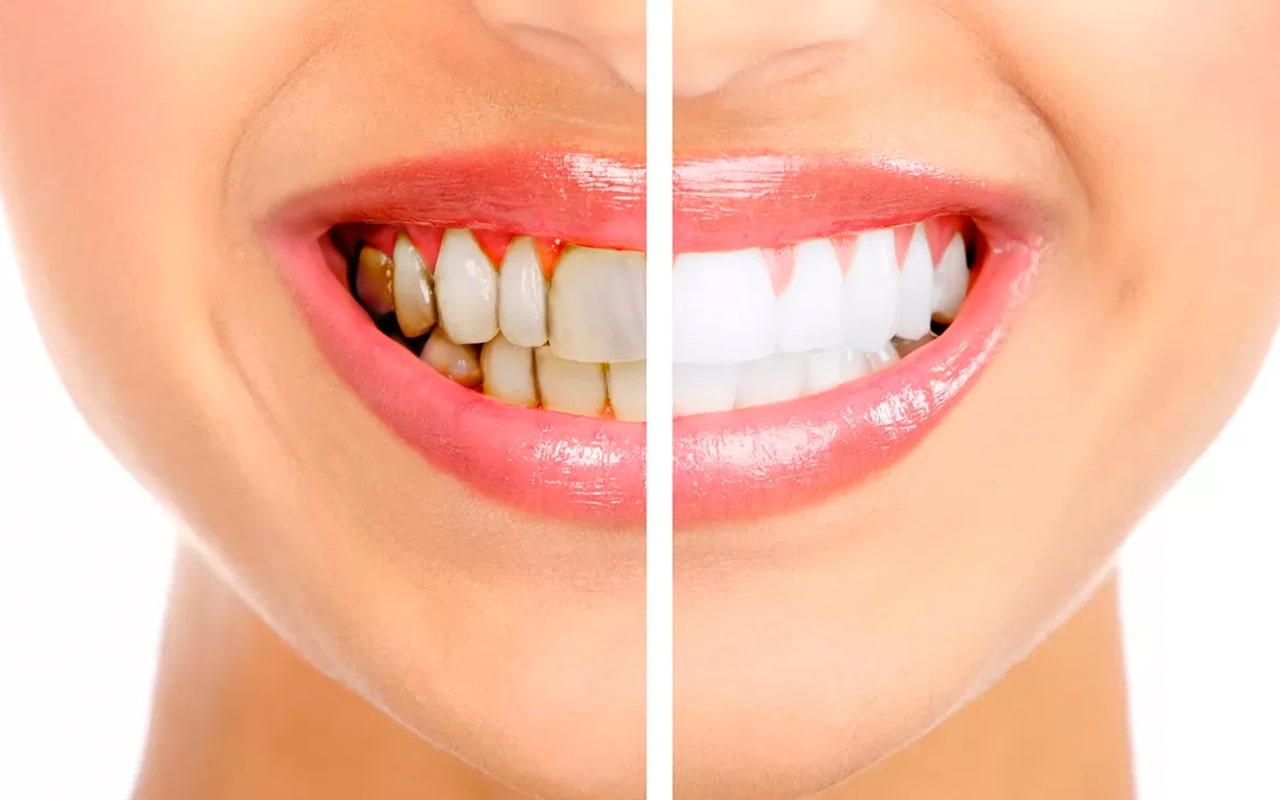 Diş Taşı Temizliği Nedir