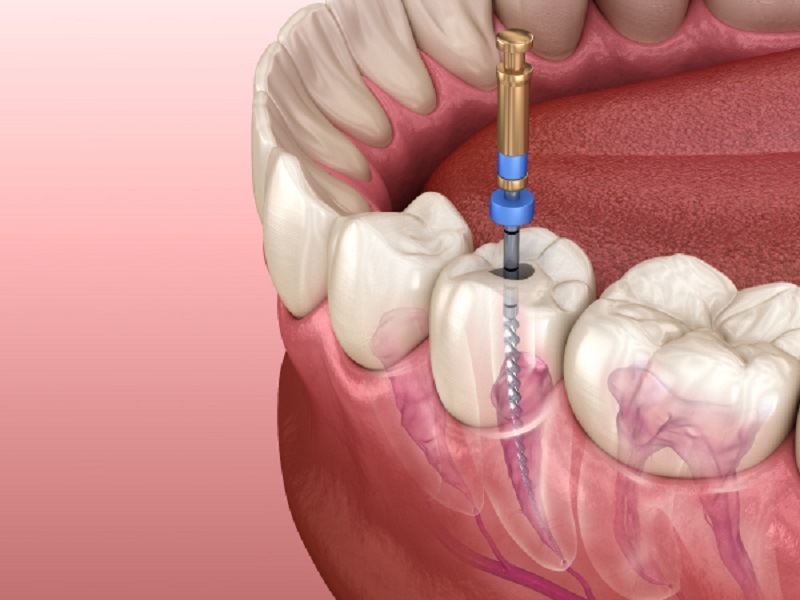 Kanal Tedavisi ve Dolgu Yapılan Diş Neden Ağrır?