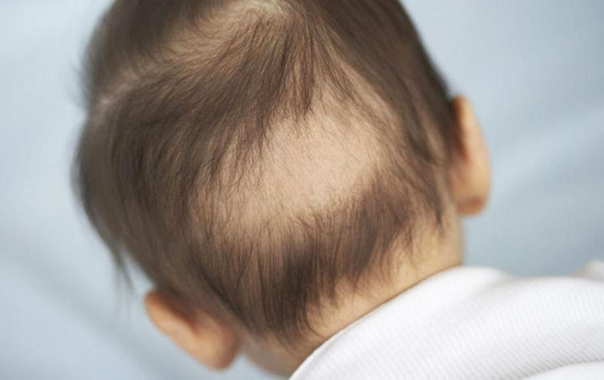 Çocuklarda Saç Dökülmesi Nedenleri