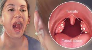 Tonsillit