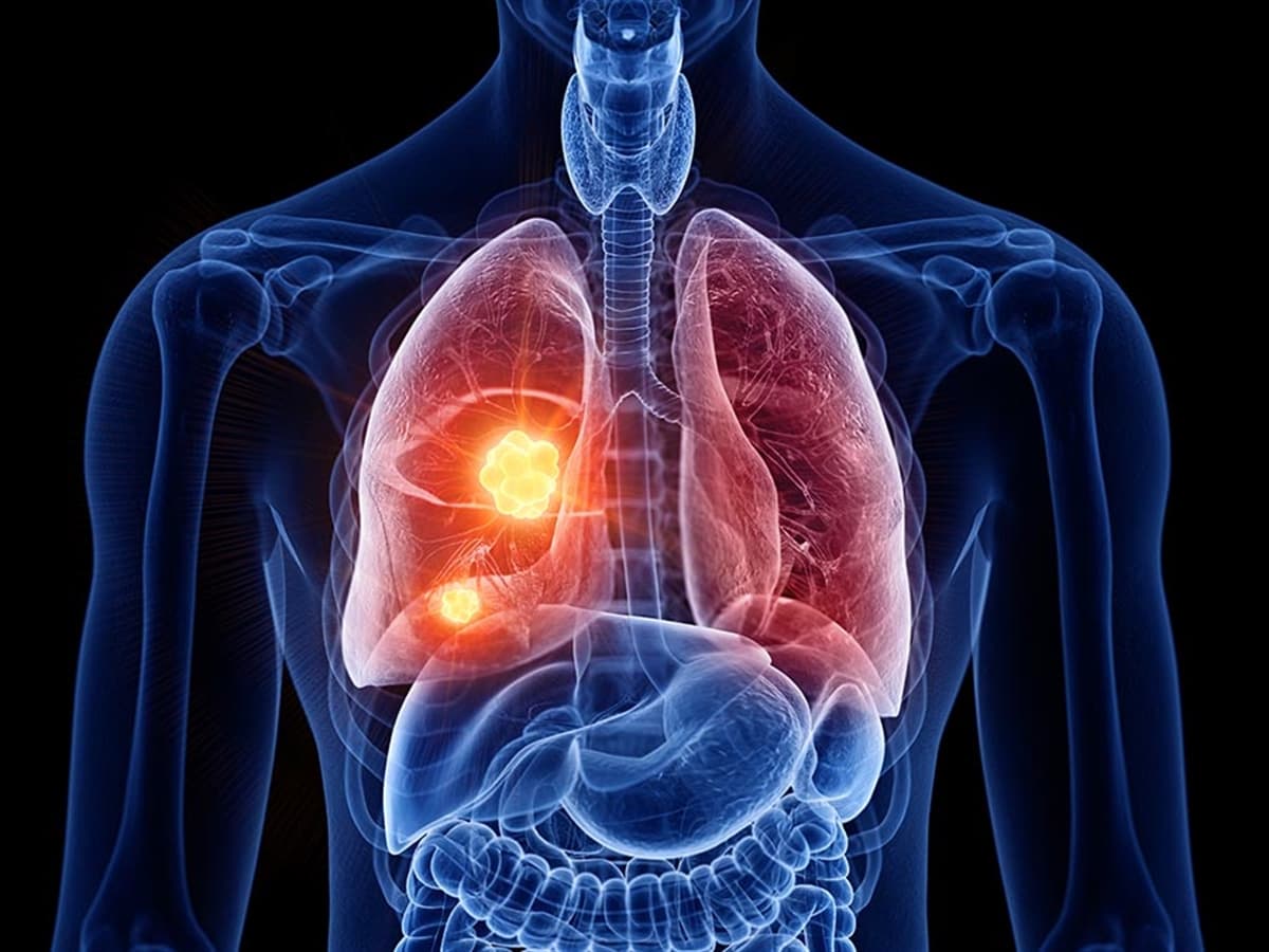 Metastatik Akciğer Kanseri Belirtileri