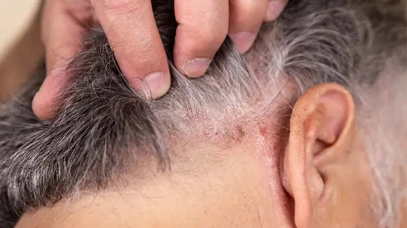 Saç Egzaması (Seboreik Dermatit): Belirtileri ve Tedavisi