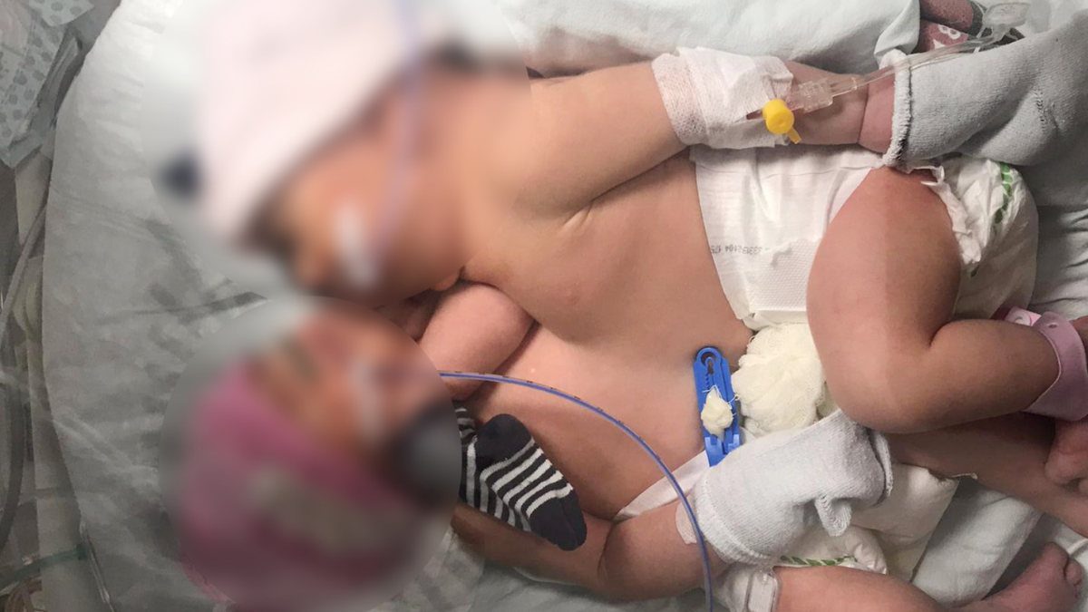 Karından ve göğüsten yapışık halde dünyaya gelen ikizler operasyonla birbirinden ayrıldı