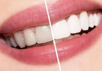 Ağız ve Diş İçin Doğal Bakım Önerileri